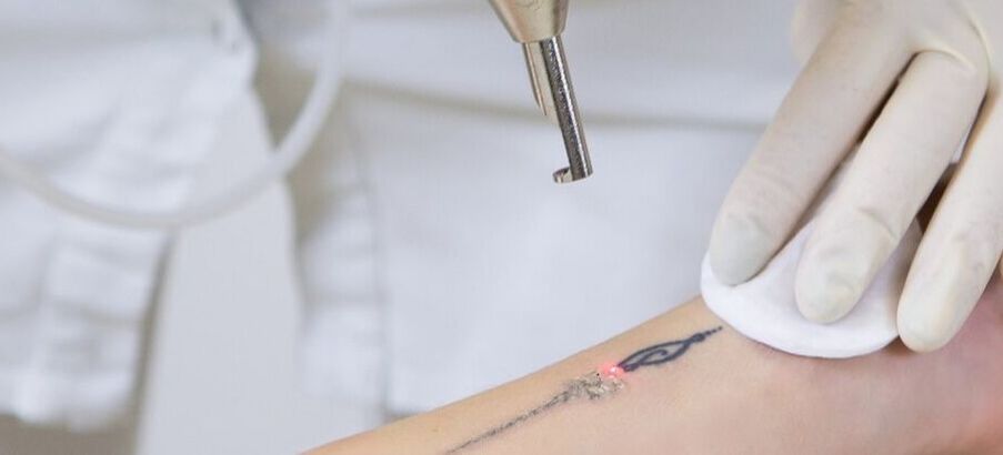 NZ Laser Tattoo Removal
